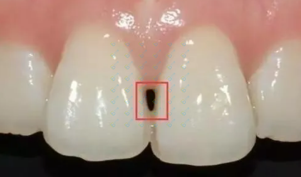 讓人聞風(fēng)喪膽的牙齒“黑三角”，比齲齒更可怕！