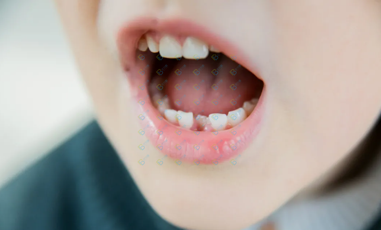孩子好好的乳牙怎么越長越歪了呢？