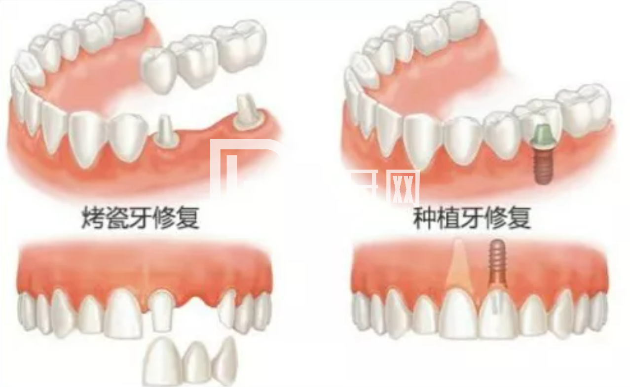 老人種牙對身體條件有要求嗎？