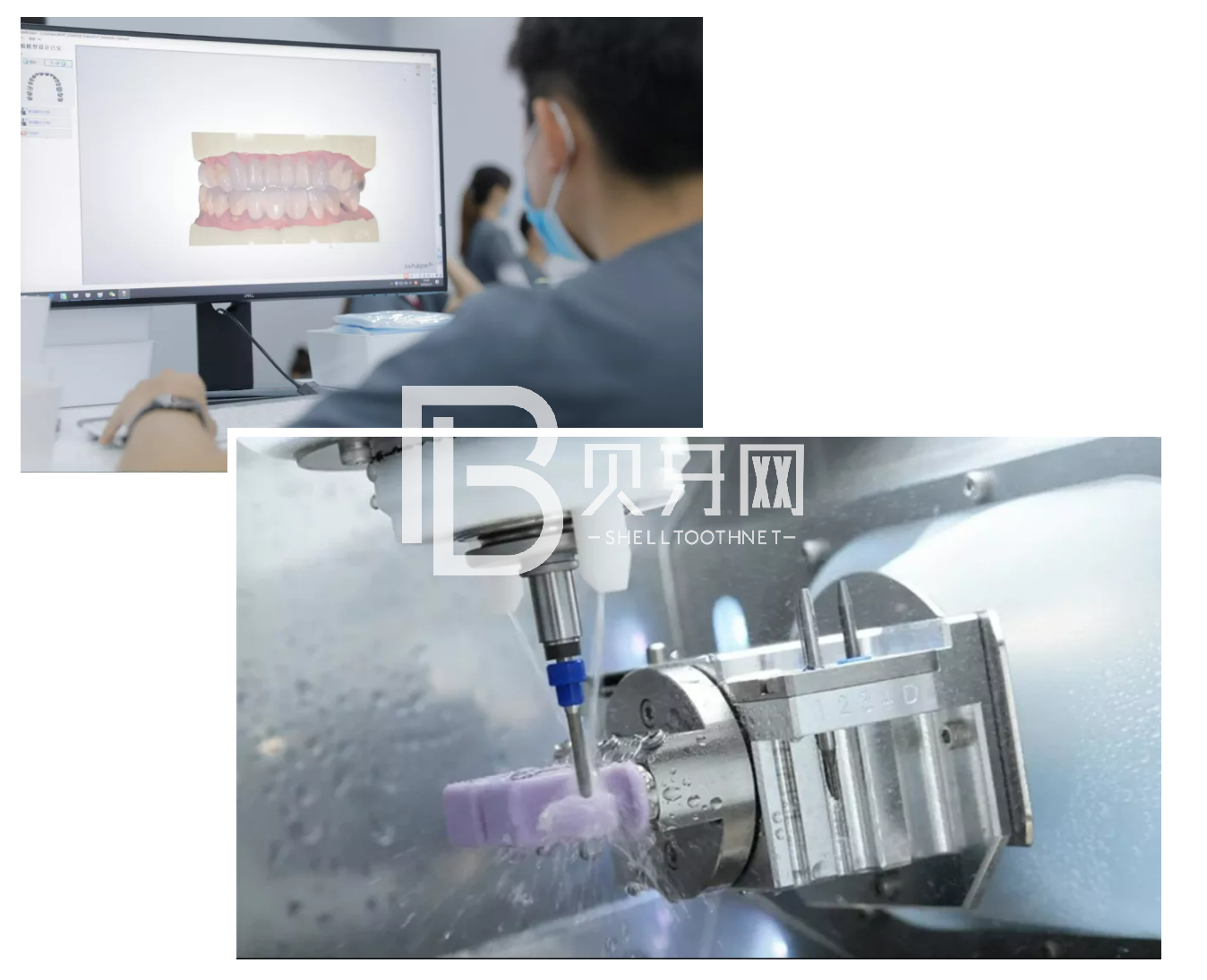 缺牙后最容易陷入的誤區(qū)，您中招了嗎？