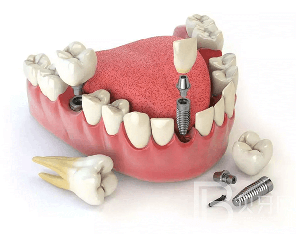 不到60歲，牙齒就所剩無幾了？這5件護(hù)牙小事，別等老了再做！