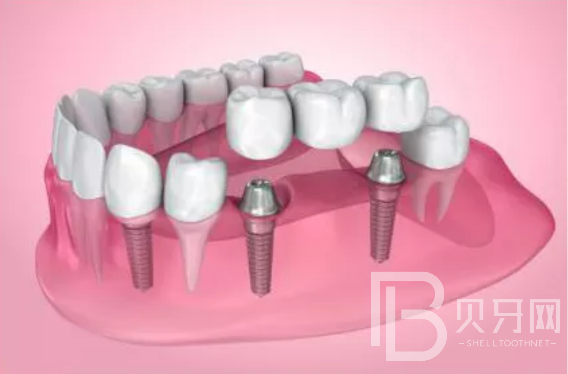 拔牙后一般多久能做種植牙？選什么植體比較好？