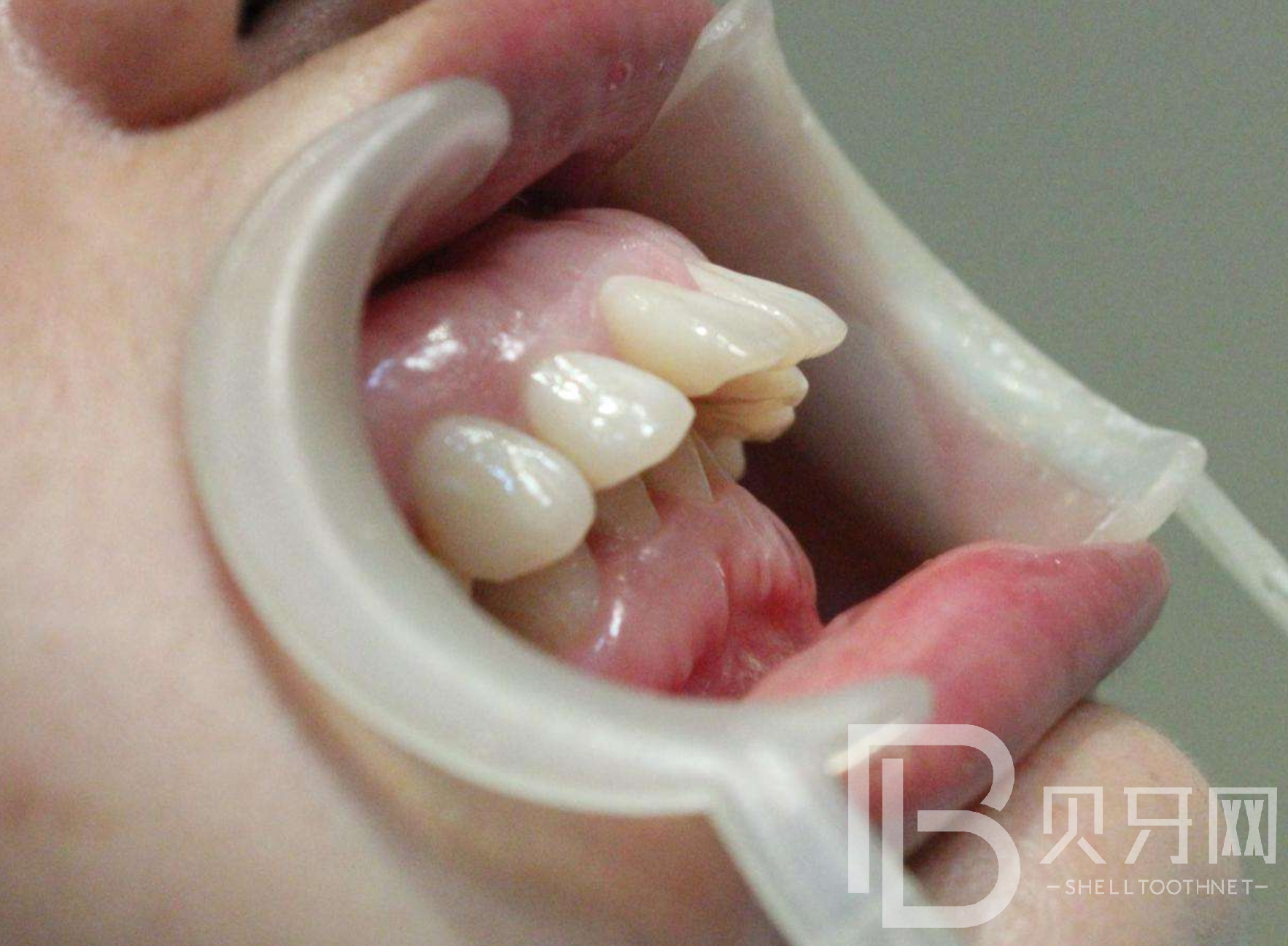 關(guān)于牙齒健康的4個(gè)秘密，你知道幾個(gè)？