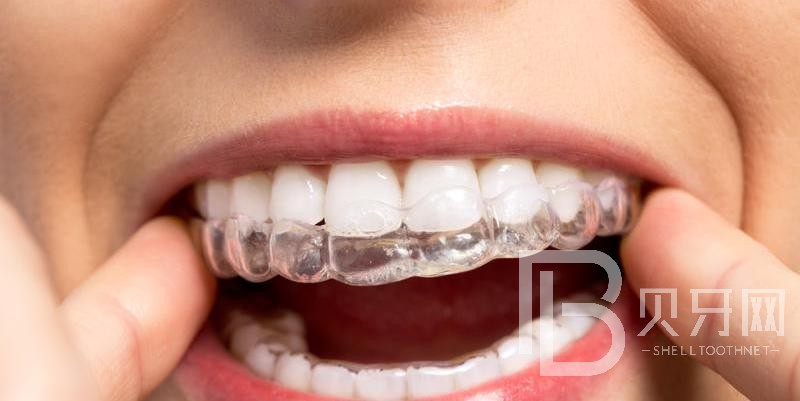 牙齒矯正后容易反彈嗎?這種情況需謹(jǐn)慎！