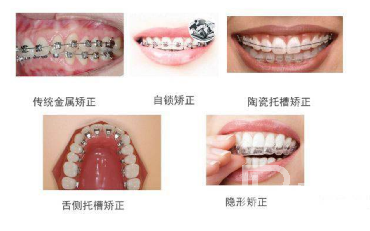 牙齒不整齊都有哪些矯正方式?分別價格多少錢？