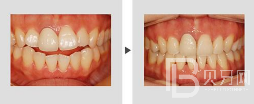 牙齒不齊一定要矯正嗎？還有哪些方式可以改變？