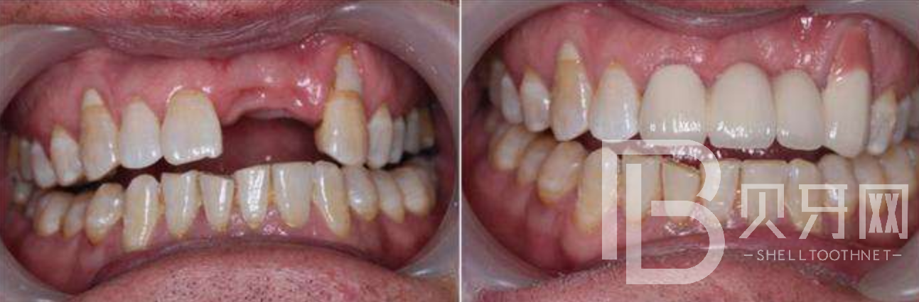 有牙周炎能不能做種植牙？