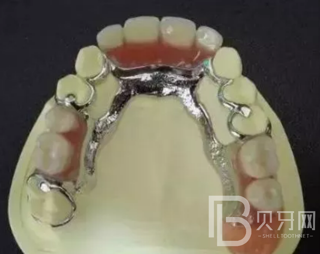 牙齒缺失一顆哪種修復(fù)方式好？