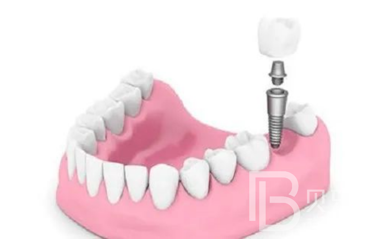 多顆牙缺失做種植牙需要多少錢？