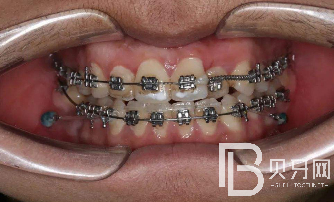 牙齒矯正之前，這幾件事一定要知道