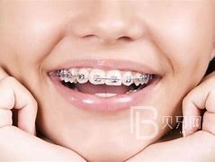 好好的一張嘴，外面看起來(lái)也沒有什么問(wèn)題，為什么一定要矯正？不同于地包天、牙列擁擠、開頜等牙齒問(wèn)題，深覆合更多的是對(duì)牙齒隱形的傷害。