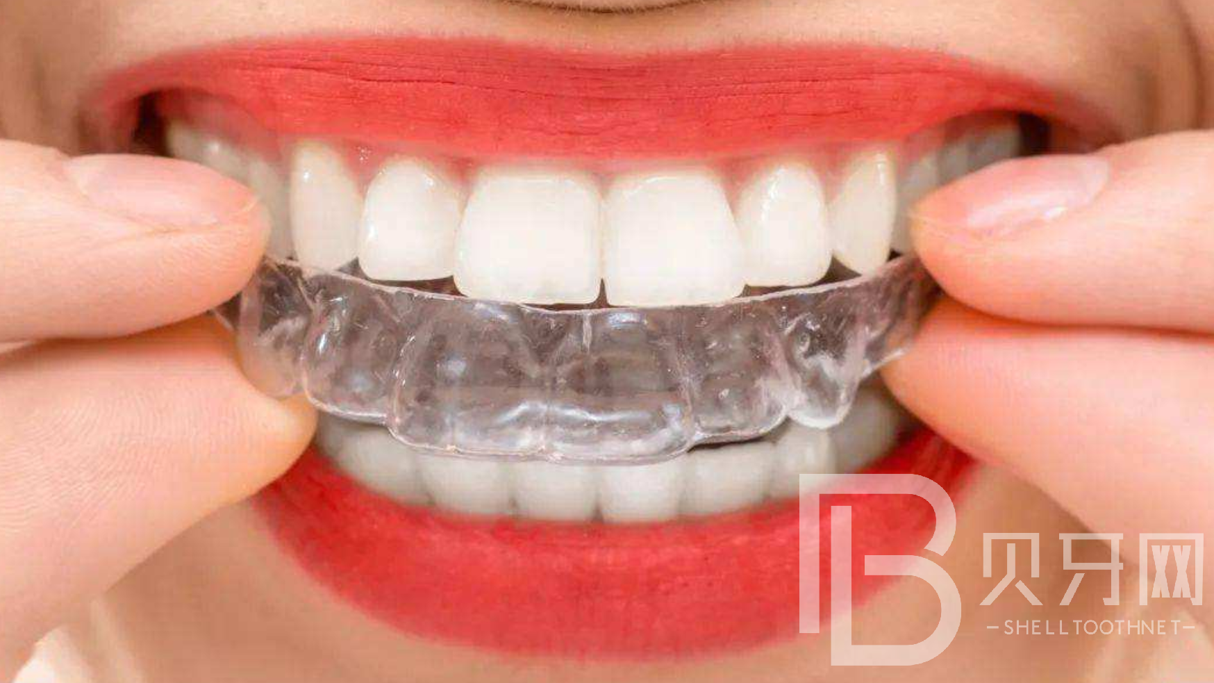 怎么讓牙齒變整齊又好看，三種常見方法了解一下