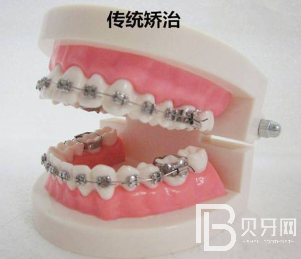 牙齒矯正需要多久，流程是什么樣的？