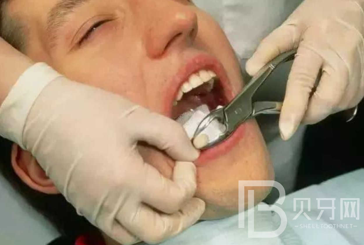 拔牙的注意事項有哪些，這幾個你一定要知道