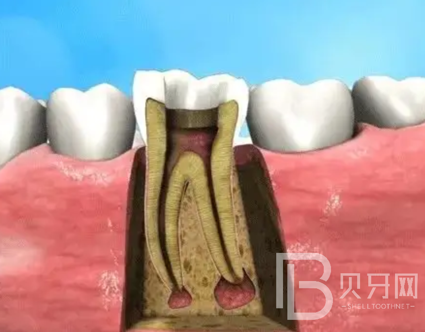補(bǔ)牙和根管治療有什么區(qū)別？