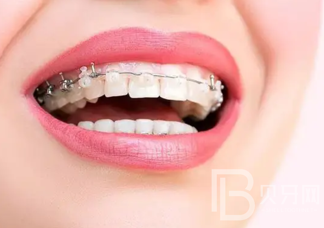 隱形牙套、鋼托槽、陶瓷托槽有什么區(qū)別？