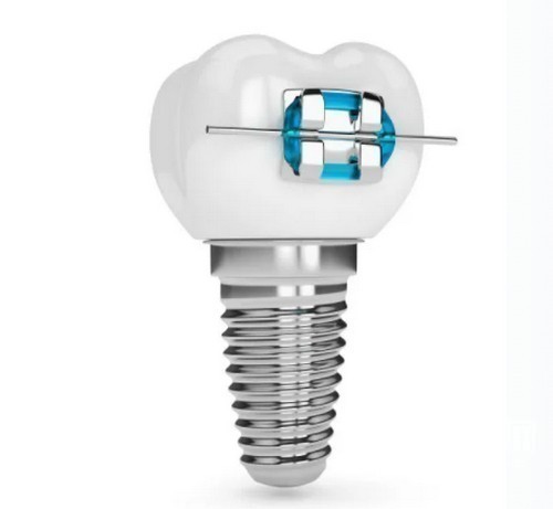 若問(wèn)上?？梢苑N牙嗎?哪家醫(yī)院好?哪里便宜?得認(rèn)準(zhǔn)這幾家!