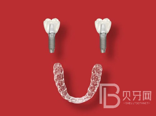 上海成人牙齒矯正大概價(jià)格多少錢，費(fèi)用價(jià)格都是怎么算的