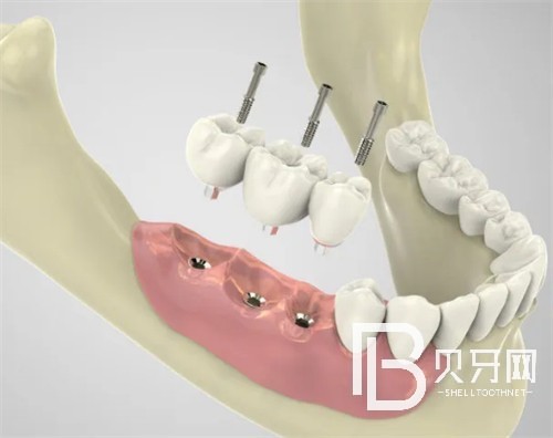 北京中諾口腔醫(yī)院種植牙怎么樣？價(jià)格貴不貴？