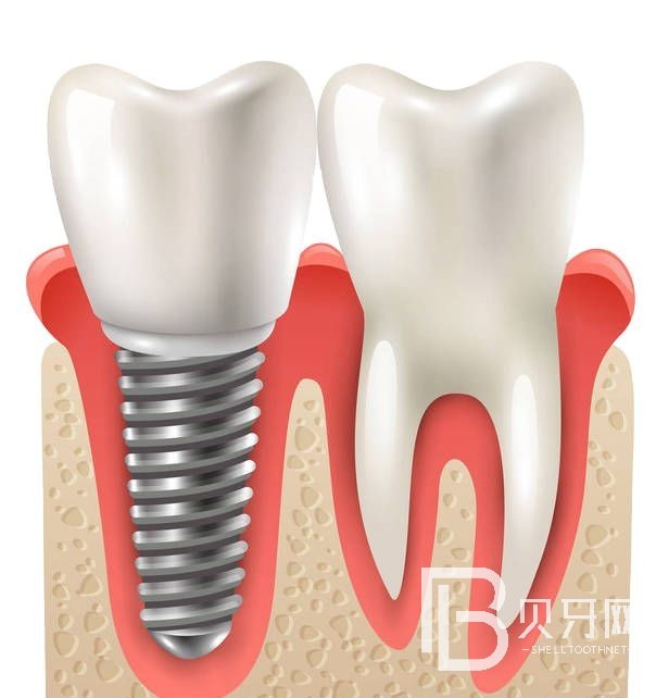 佛山登特口腔怎么樣？佛山超九成種植牙選登特口腔