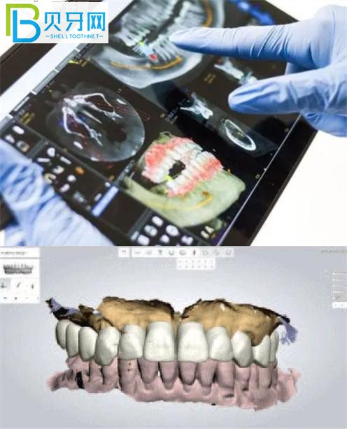 美奧口腔種植牙技術(shù)怎么樣 徐州的單顆半口都多少錢？