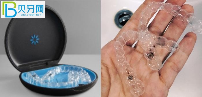 珠海隱形牙套哪家醫(yī)院比較好?推薦暨博口腔技術(shù)好價不高!