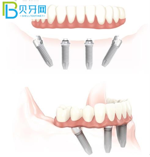上海美呀口腔種植牙正規(guī)嗎