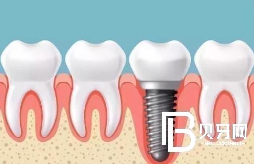 蘇州種植牙哪里好？蘇州美呀植牙值得信賴