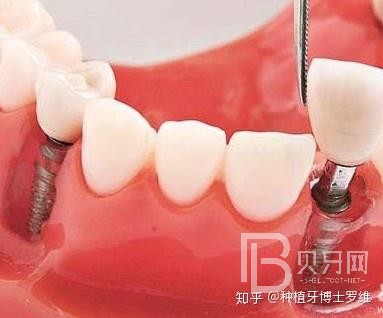 種植牙怎么樣？看看深圳諾德口腔怎么說！