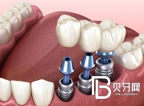 老年種植牙的利與弊？北京維爾口腔種植牙好不好？