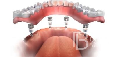 全口種植牙需要種幾棵？北京維樂口腔種植牙技術(shù)怎么樣？