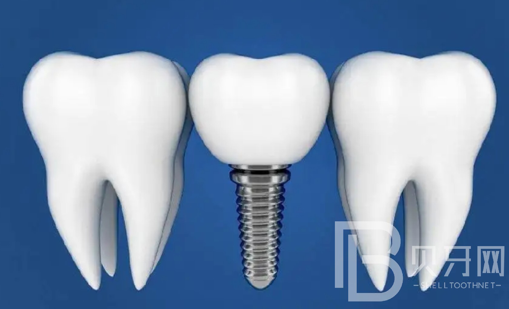 半口種植牙大概要幾次完成？北京美冠塔口腔種植牙怎么樣？