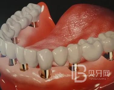 廣州廣大口腔老年人種植牙價格，全口種植牙需要種幾棵