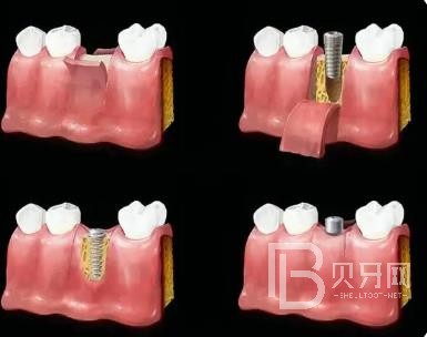 廣州圣貝口腔口碑好不好？靠譜嗎？70歲的老年人可否種植牙