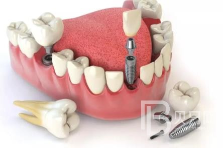 廣州拜博口腔口碑好不好？靠譜嗎？廣州拜博口腔種植牙多少錢