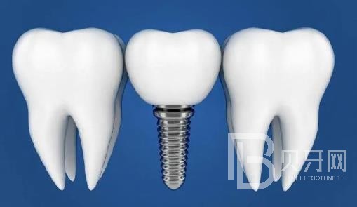 廣州瑞爾口腔老年人能做種植牙嗎？廣州瑞爾口腔價(jià)格多少錢