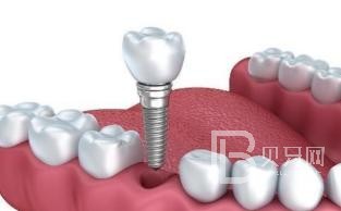 60歲老年人種植牙哪家好？北京鈦植口腔怎么樣？