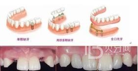 60歲的人種植牙還是鑲牙好？北京冠美口腔怎么樣？