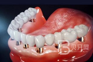 半口種植牙要種幾顆？北京維樂(lè)口腔正規(guī)嗎？