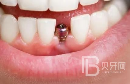 廣州暨博口腔怎么樣？廣州暨博口腔口碑好不好？廣州暨博口腔種植牙價格