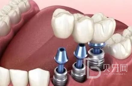 廣州諾爾口腔怎么樣？廣州諾爾口腔種植牙一顆多少錢