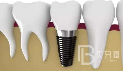 廣州曙光口腔正規(guī)靠譜嗎？醫(yī)院位置在哪？廣州曙光口腔種植牙價(jià)格