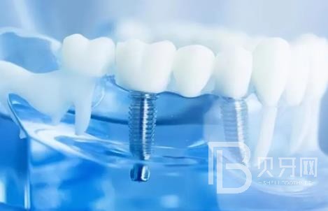 廣州友睦口腔怎么樣？廣州友睦口腔口碑好不好？廣州友睦口腔種植牙價(jià)格