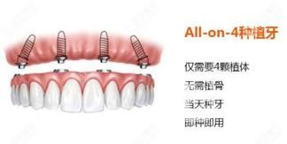 全口種植牙需要種植幾顆？北京永康口腔怎么樣？