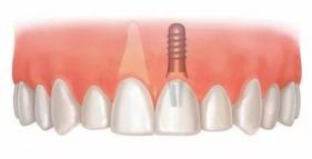 老年人適合的種植牙？北京諾美口腔怎么樣？