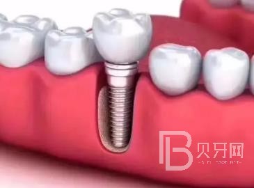 廣州研科口腔醫(yī)院怎么樣？廣州研科口腔口碑好不好？廣州研科口腔種植牙多少錢