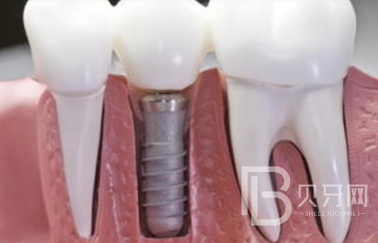 廣州柏德口腔怎么樣？廣州柏德口腔種植牙一顆多少錢