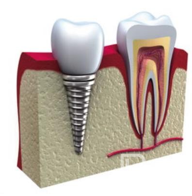 廣州德祥口腔怎么樣？廣州德祥口腔口碑好不好？廣州德祥口腔種植牙價格