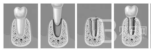 深圳瑞爾口腔半口種植牙即刻負(fù)重