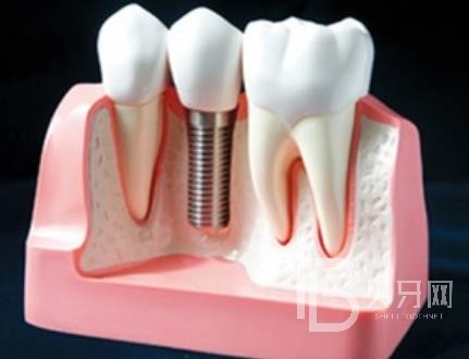 廣州悠美口腔怎么樣？口腔口碑好不好？口腔種植牙價(jià)格